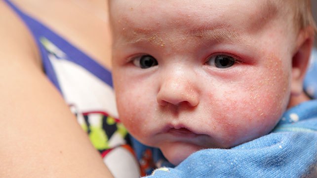 The Ultimate Guide on Baby Acne & Tips for Treatment | Planet Awesome Kid